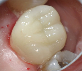 Donato-Dental-CEREC-computer-designed-and-manufactured-porcelain-crown-restoration
