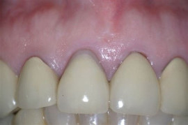 Donato-Dental-One-month-post-op-with-excellent-tissue-response