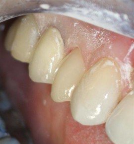 At Donato Dental, we have been using CEREC Technology to create natural-looking porcelain restorations since 2004.
