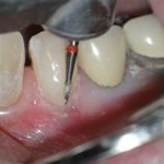 The margins of the restoration are now smoothed. It is particularly important that the restorative margin near the gum tissue is perfectly smooth and free of voids and overhangs so that plaque and bacteria do not easily accumulate and propagate there.