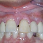 This photo was taken a year post-operatively. While it could be argued from a cosmetic standpoint that an extraction and implant could have produced a more cosmetically pleasing result, this patient was more concerned in not losing her own front tooth. Every patient is different, and for some, losing a front tooth can be psychologically traumatizing.