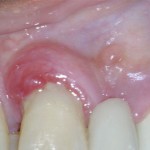 Pre-operative close-up view. Note the exudate of puss (suppuration) from the gingival margin.