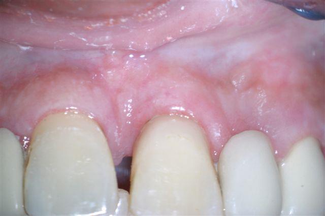 In addition to resolving the acute inflammatory condition, tooth mobility was also significantly reduced.