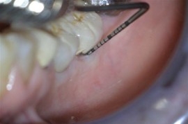 Pocket depth was reduced from 7mm to 3mm. Note also that the gingiva no longer bleeds upon probing.
