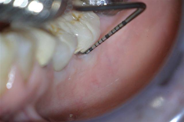 Pocket depth was reduced from 7mm to 3mm. Note also that the gingiva no longer bleeds upon probing.