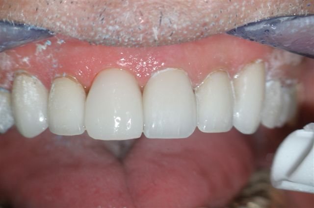 One Visit CEREC Crown Replaced