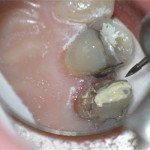 The adjacent tooth with the silver filling has a ledge (overhang) of filling material below the gum line. Overhangs accumulate plaque and makes it difficult for patients to floss without getting the floss hung-up. While I am in there working, I will address issues like this whenever I have access. Removing the old crown therefore provided access and an opportunity to smooth things up!
