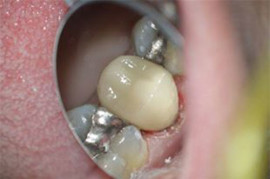 View of new CEREC crown from other side.  Thanks for watching!