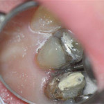 Amalgam overhang being smoothed which will help make flossing easier for this patient.